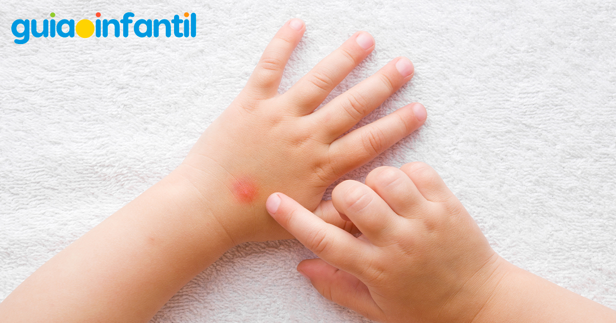 Picaduras de insectos en los niños