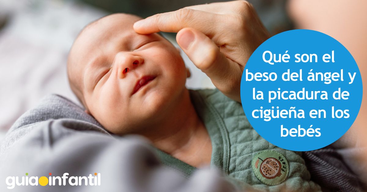 Beso de ángel en bebés