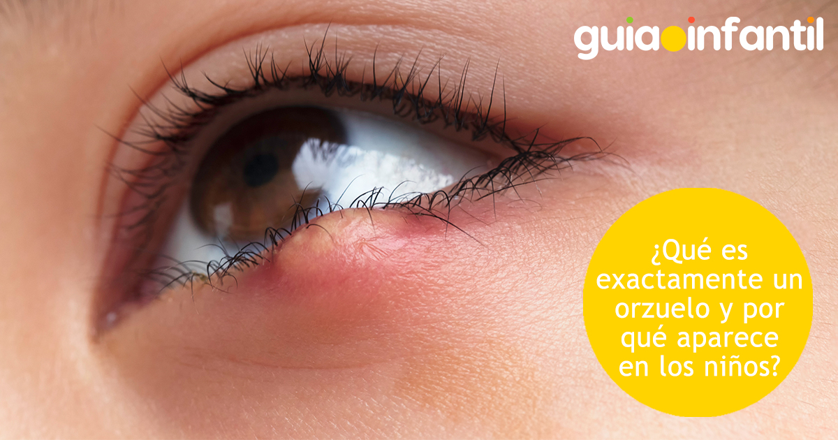 Qué es un orzuelo