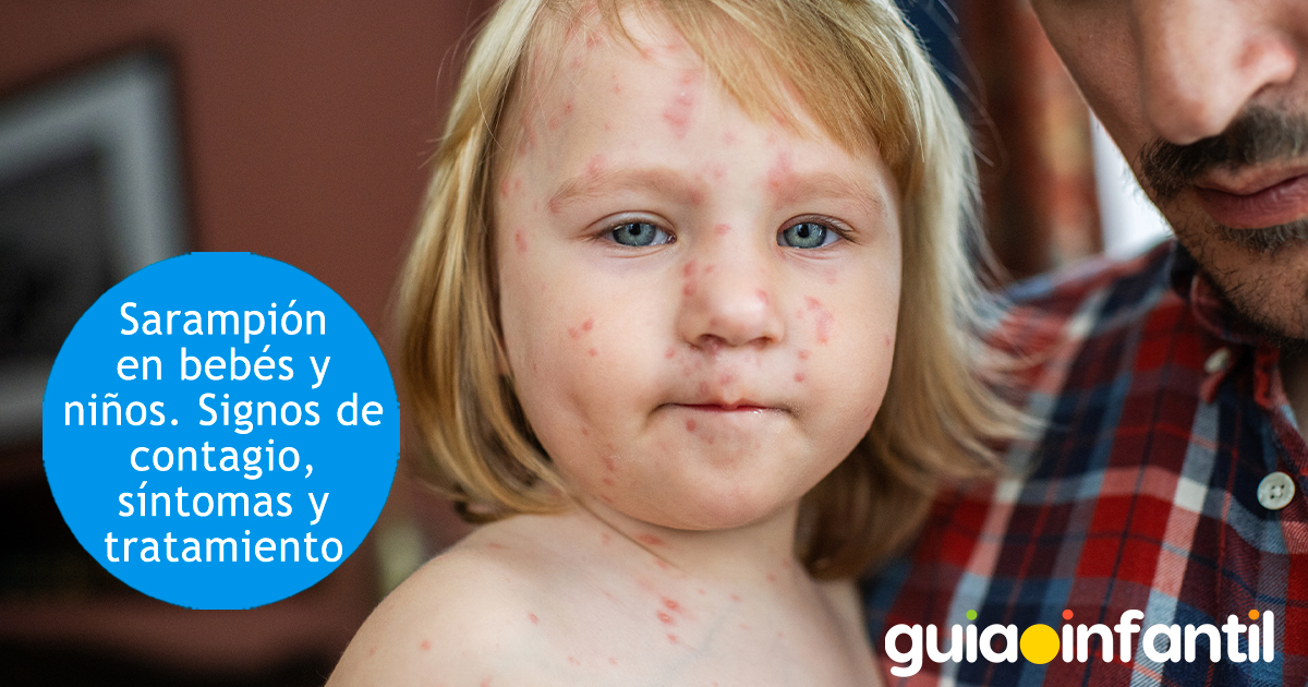 Síntomas y tratamiento del sarampión en los niños Síntomas y tratamiento del sarampión en los niños