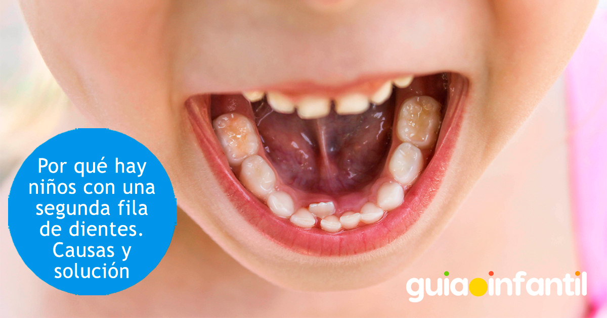 Por qué hay niños con doble fila de dientes Niña con doble fila de dientes