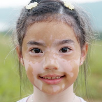 ¿Qué es el vitiligo? Cómo se manifiesta y se trata en los niños