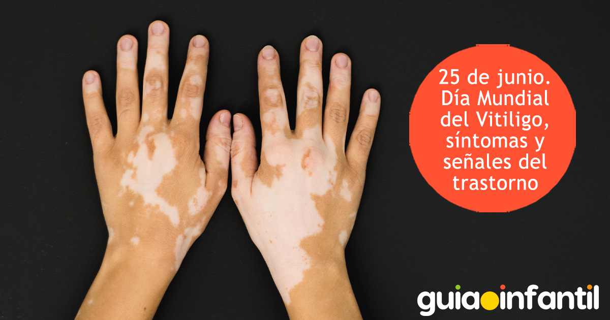 Trastorno de vitiligo en niños
