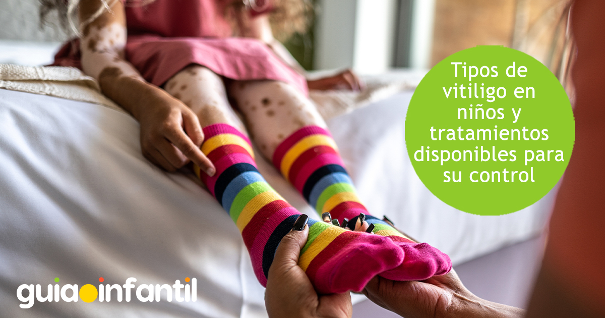 Tipos de vitiligo en niños