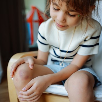 Causas comunes de hematomas y moretones en las piernas de los niños