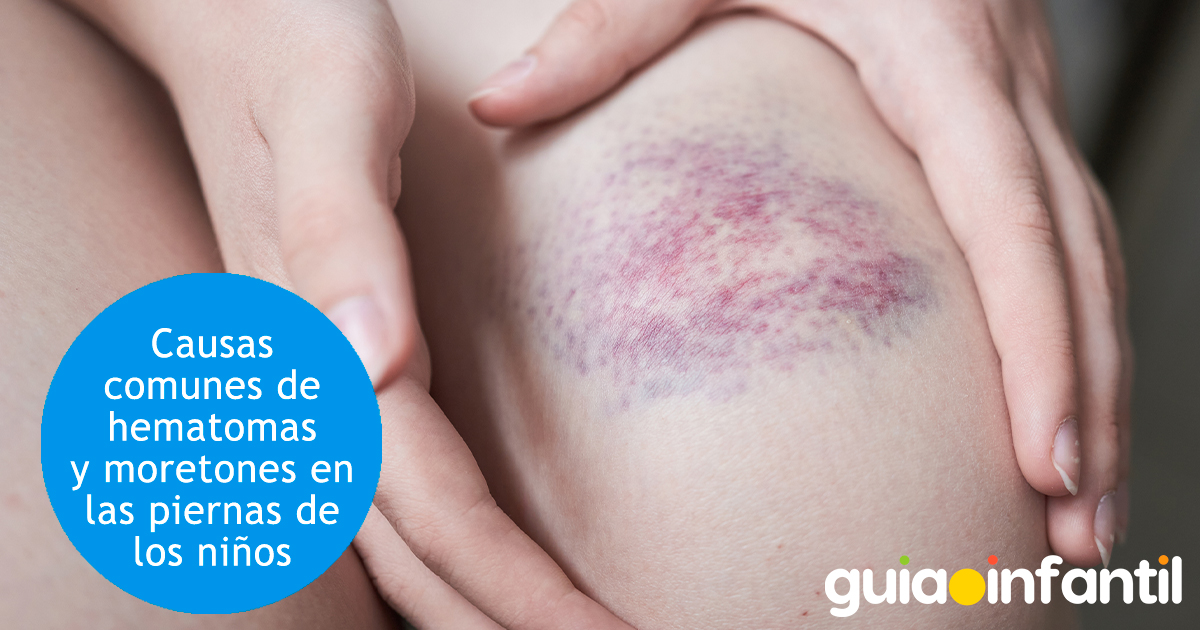 Causas de moretones en los niños