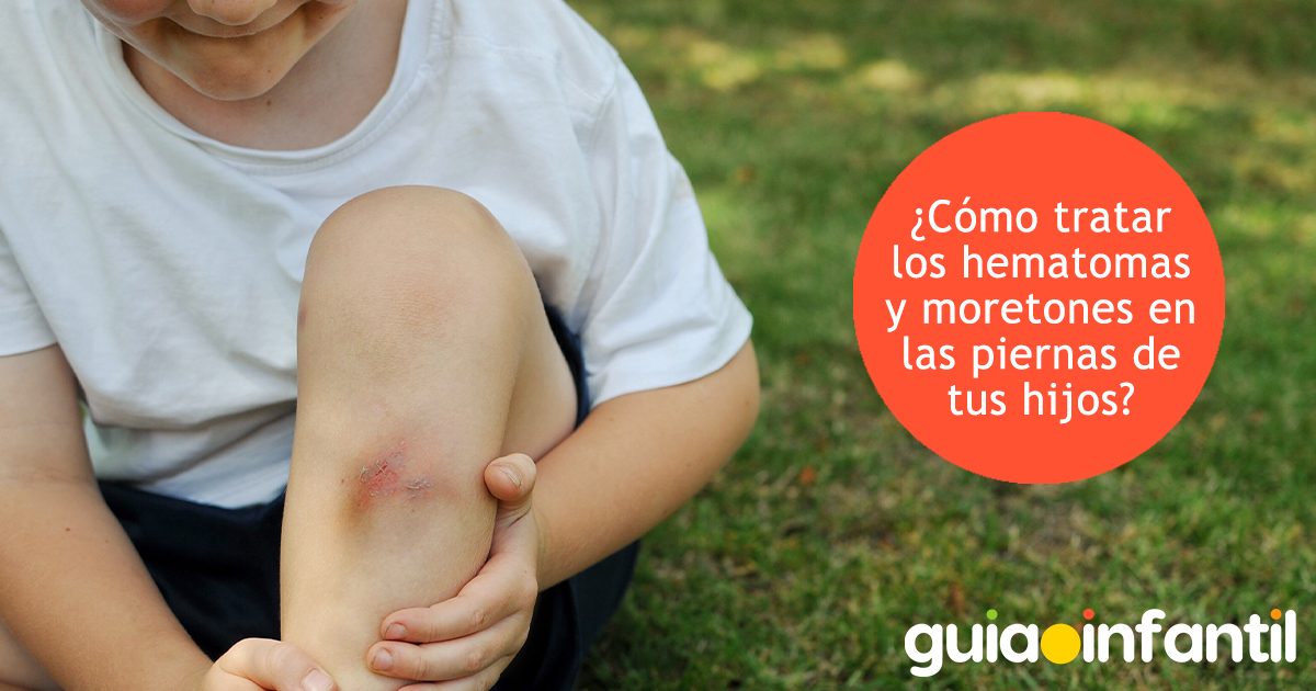 Cómo tratar los hematomas en los niños