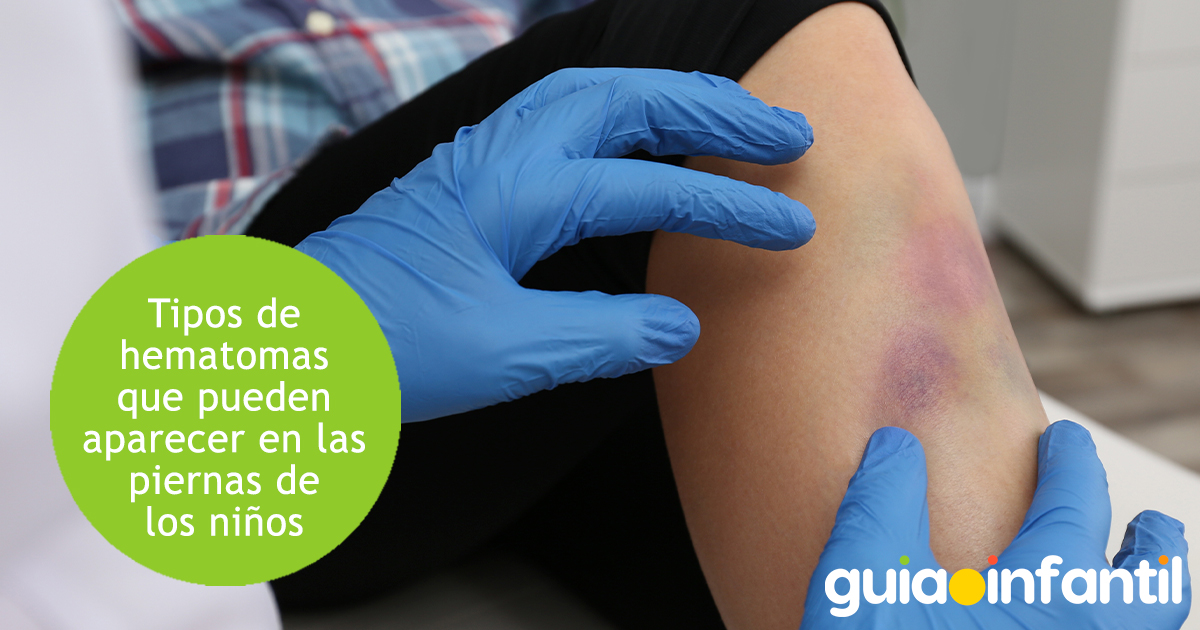 Tipos de hematomas en los niños