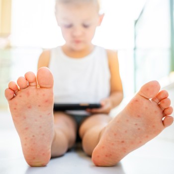 El virus mano-pie-boca en los niños - Síntomas, causas y tratamiento