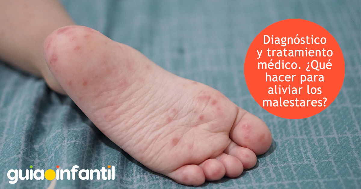 Diagnóstico y tratamiento del virus pie-mano-boca en los niños