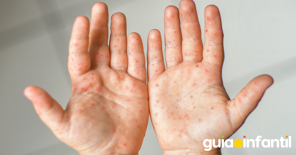 Cura del virus mano-pie-boca en niños