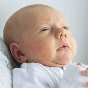 Acné neonatal, los granitos en la piel del recién nacido que asustan a los padres