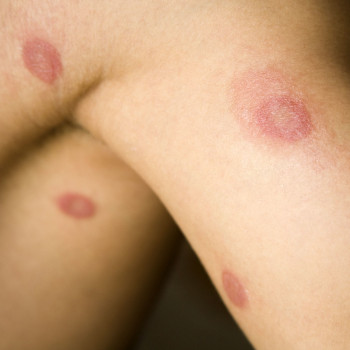 Brote escolar de tiña dispara la preocupación de los padres