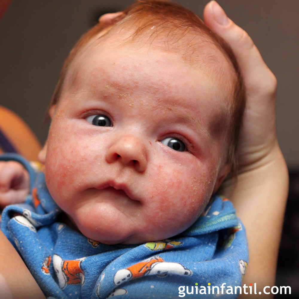 Milium O Milaria En Bebes Una De Las Lesiones Mas Comun En La Piel Del Recien Nacido