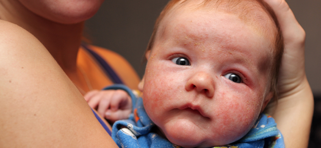 Qué es el milium o milaria