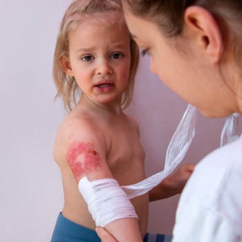 Cura de las heridas por quemaduras a los niños, paso a paso