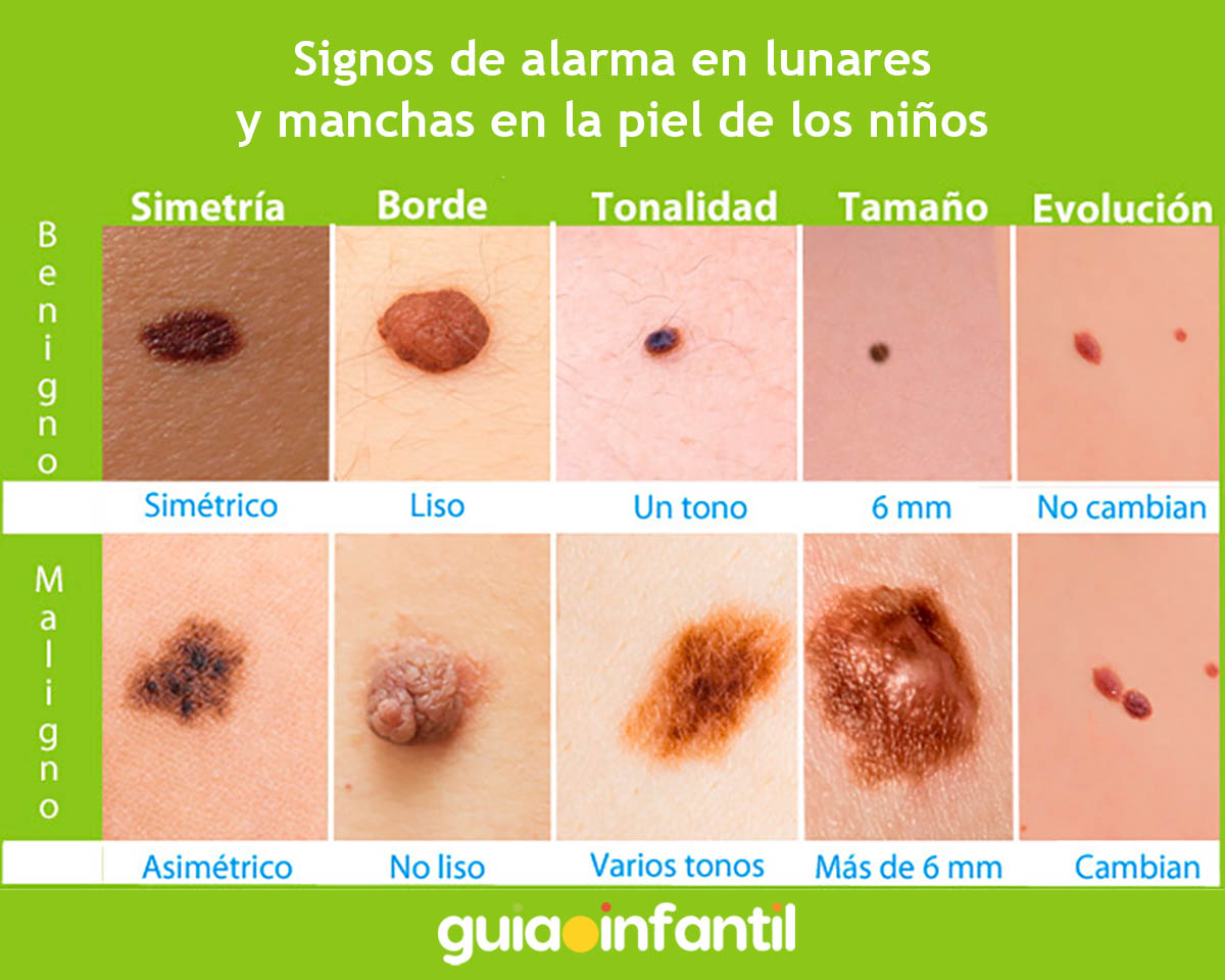 La tabla de los lunares de melanoma de los niños