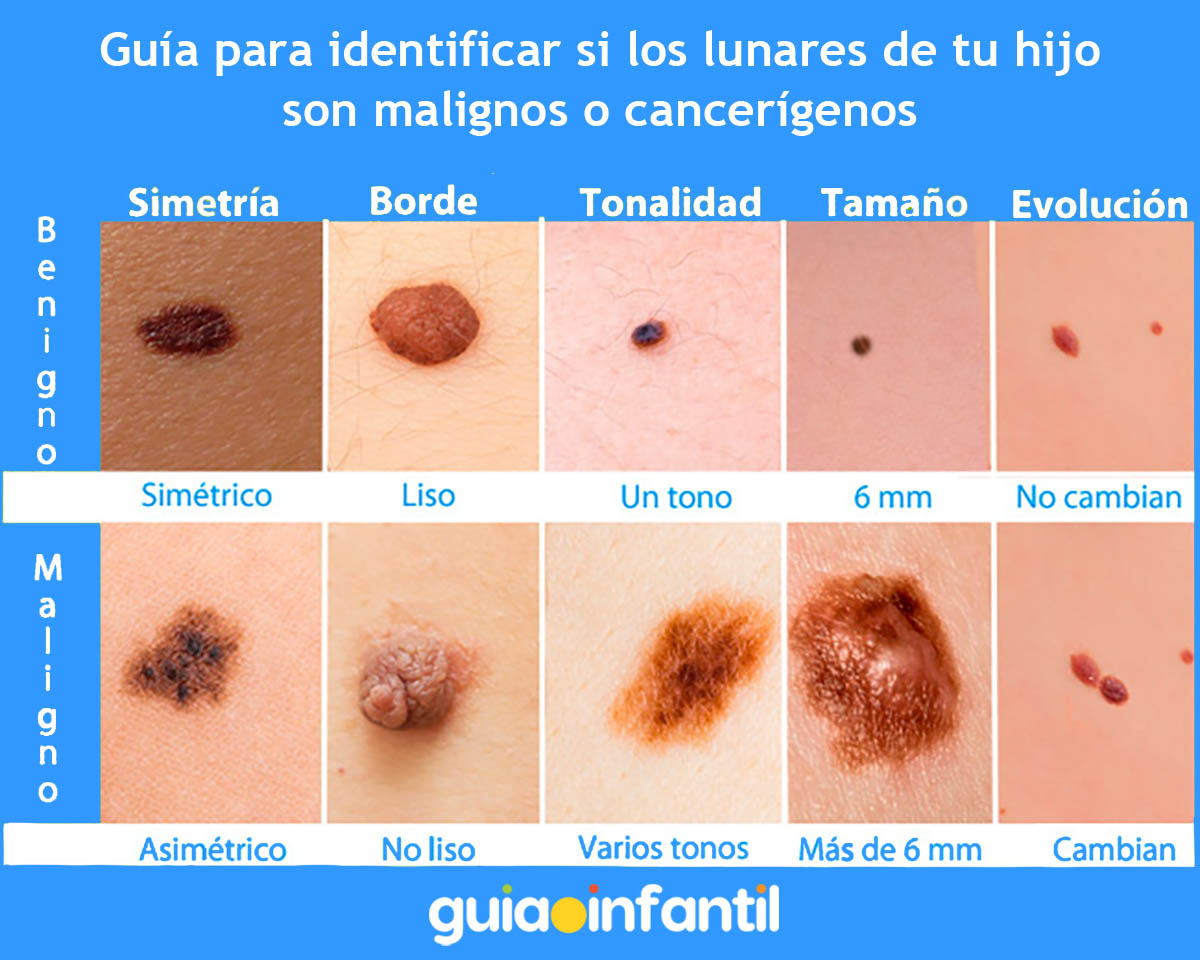 Identifica lunares cancerosos en la piel de tu hijo Identifica lunares cancerosos en la piel de tu hijo