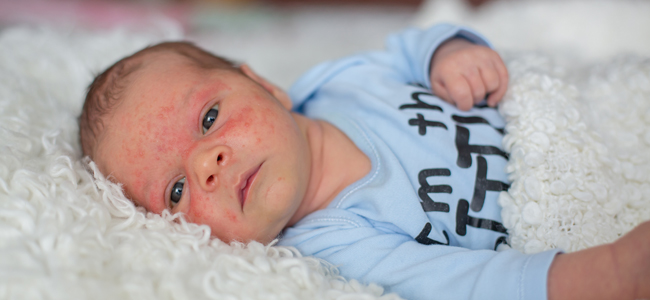 Qué es el síndrome de Gianotti-Crosti y cómo se contagia 