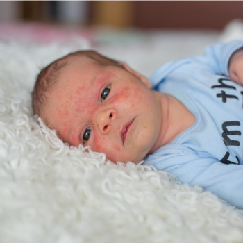 Síntomas y tratamiento del síndrome de Giannotti-Crosti en niños