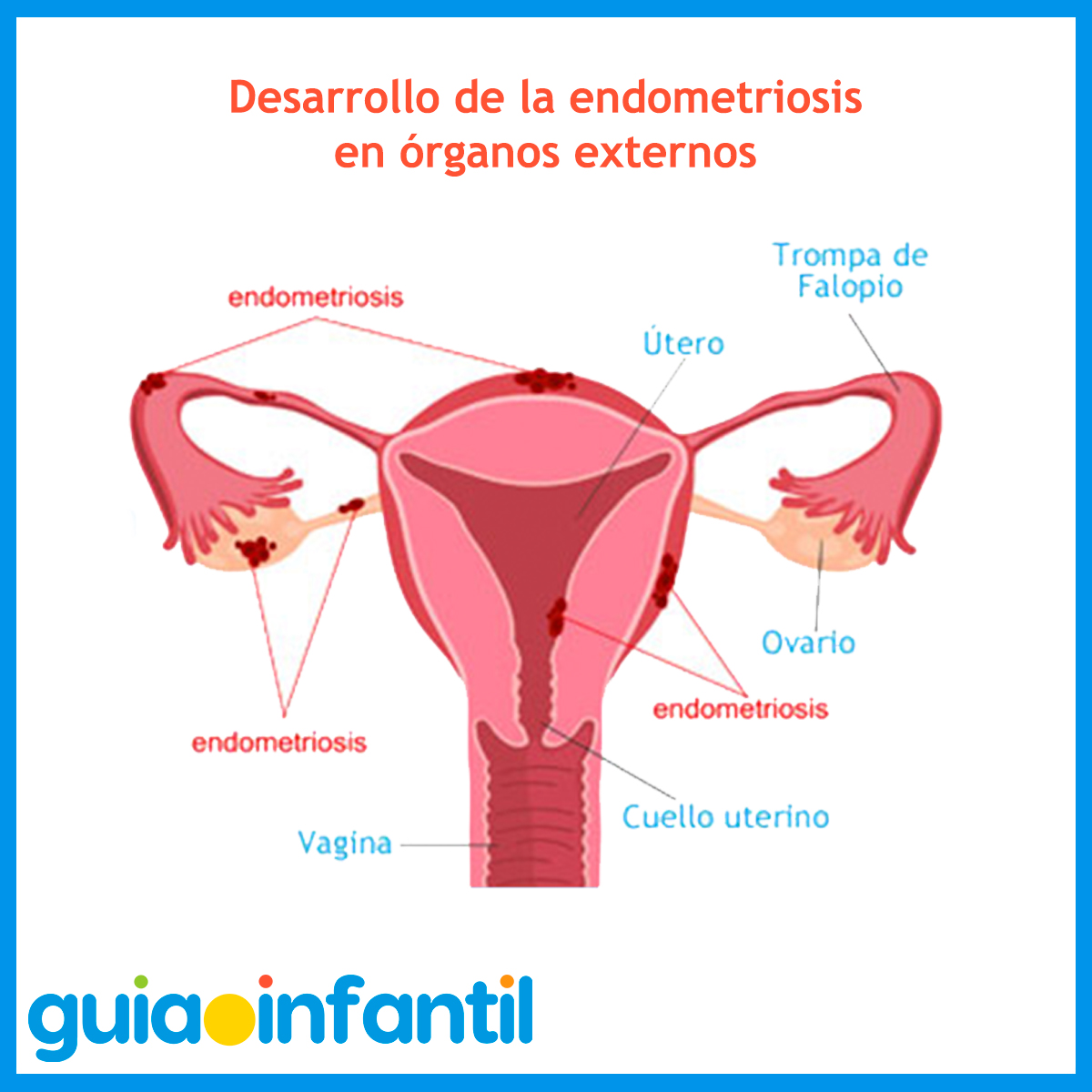 Endometriosis en las mujeres