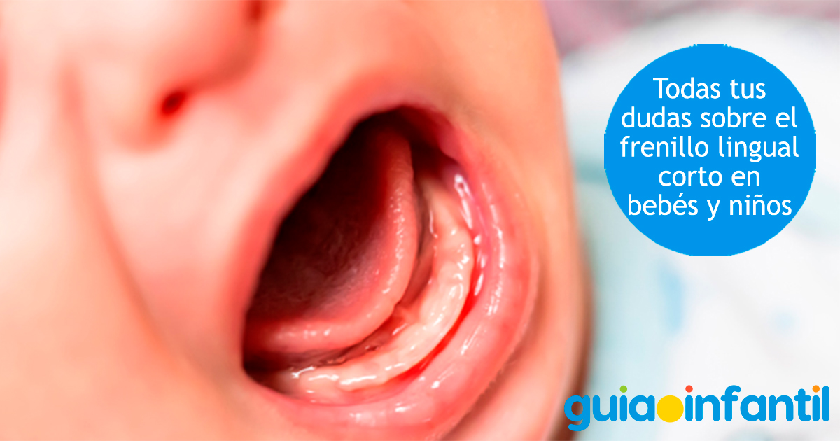 ¿Qué es el frenillo lingual en bebés?
