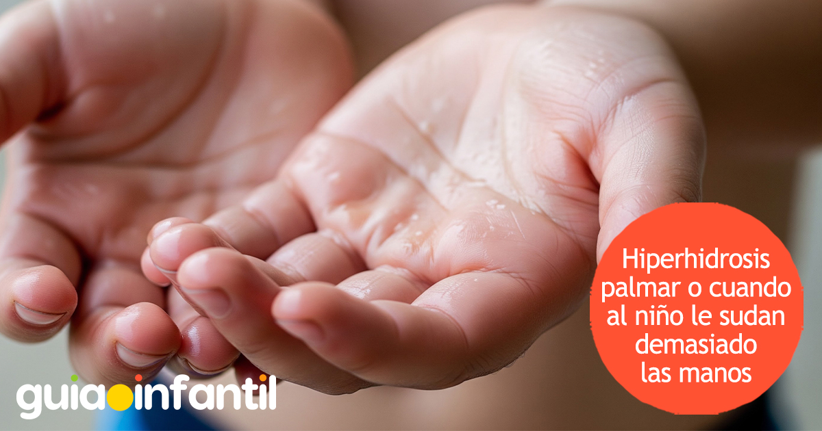 ¿Qué es la hiperhidrosis palmar?