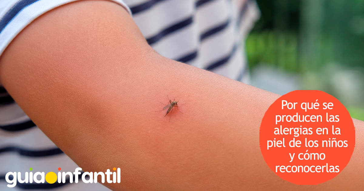 Alergias en la piel de los niños