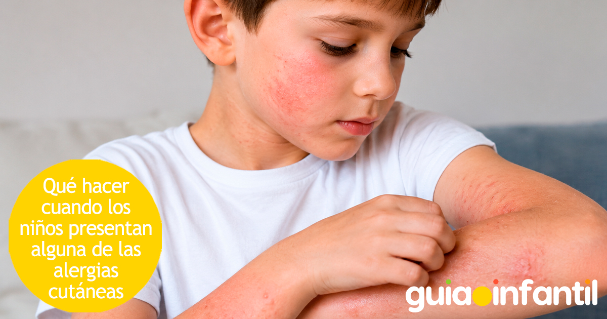 Qué hacer con las alergias cutáneas en niños