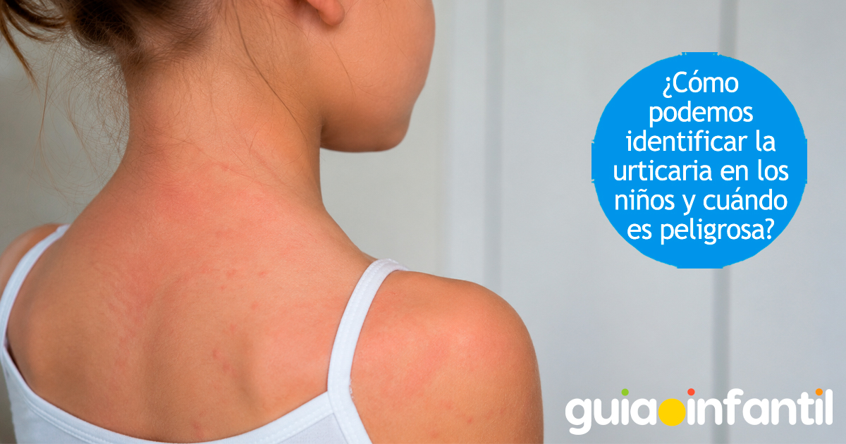 Cómo identificar la urticaria en niños