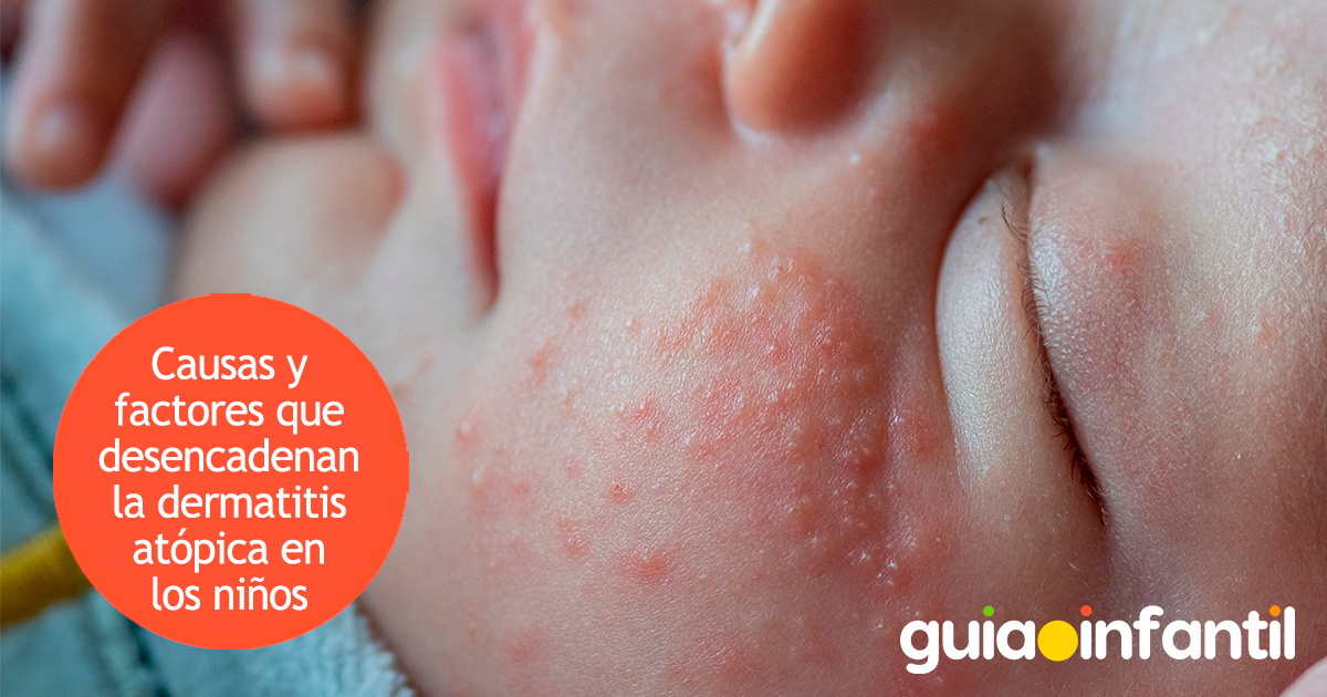 Causas y factores que desencadenan la dermatitis atópica