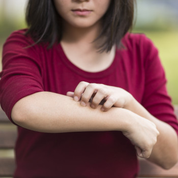 Sarna en los niños, una enfermedad de la piel muy contagiosa y molesta