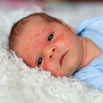 ¿Qué es la infección de la piel del bebé?