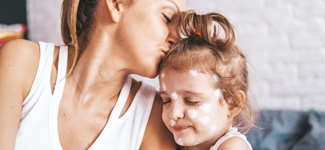 recomendaciones para tratar la varicela