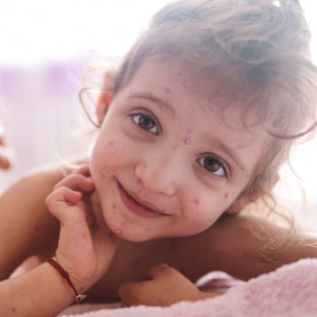 Cómo puede la varicela afectar a la salud dental de los niños