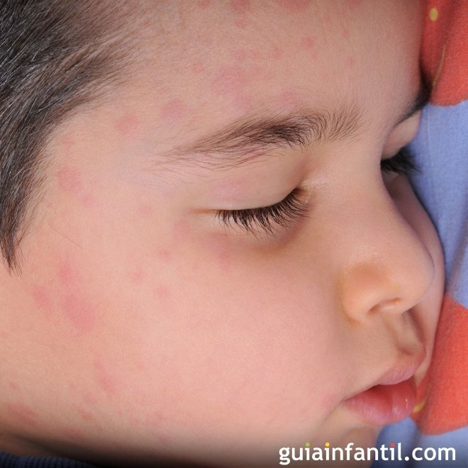 Observa si tu hijo tiene algún problema en la piel