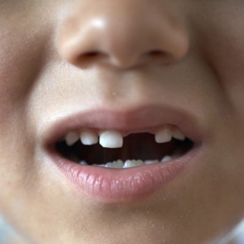 Rotura accidental de los dientes de los niños