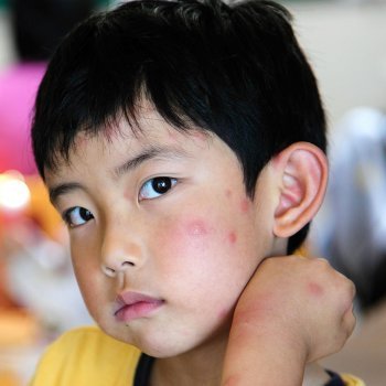 Qué es la malaria y cómo afecta a los niños