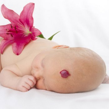 Hemangiomas en la piel del bebé