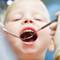 Los empastes en los dientes de leche de los niños