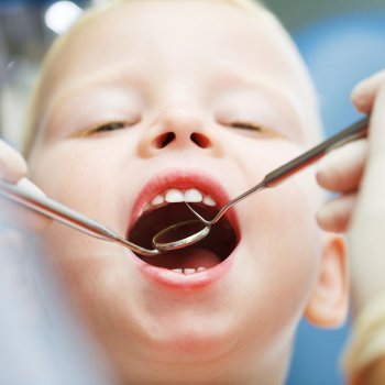 Los empastes en los dientes de leche de los niños
