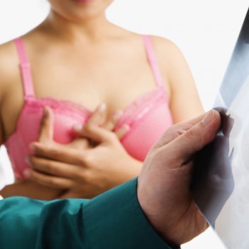 Qué es la mastectomía preventiva