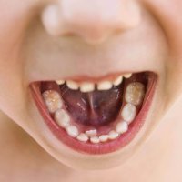 Por qué hay niños con una segunda fila de dientes