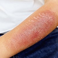 Cura de las heridas por quemaduras a los niños, paso a paso