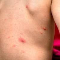Qué es la culebrilla y cómo afecta a los niños