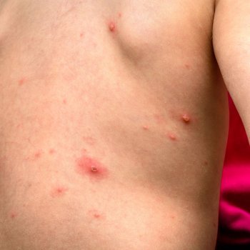 Qué es la culebrilla y cómo afecta a los niños