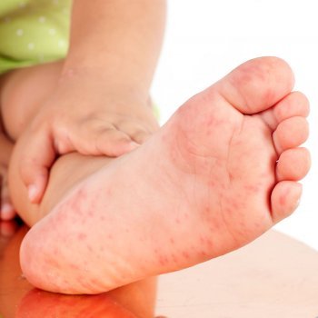 Urticaria infantil