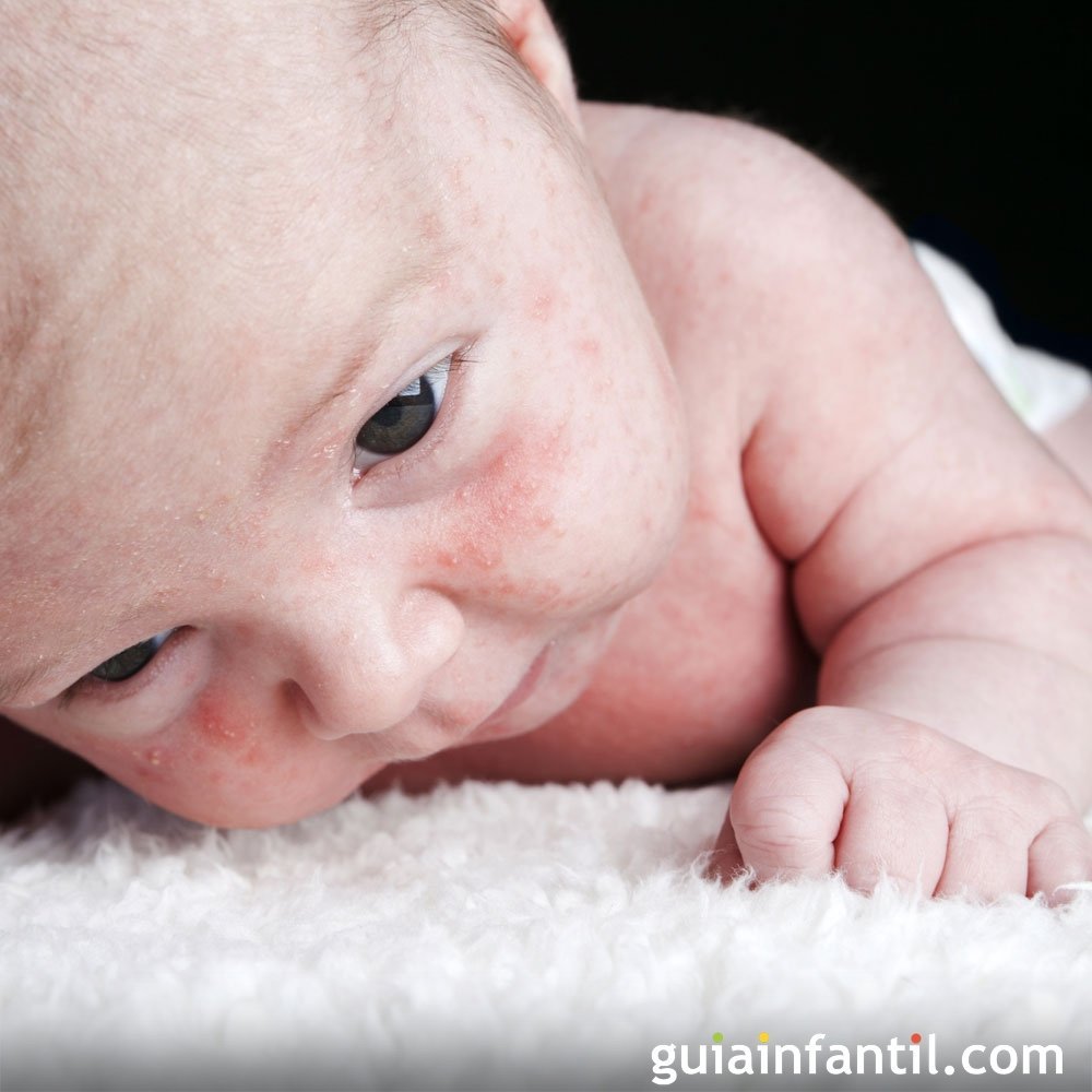 frío aborto ventajoso Sudamina, granitos en los bebés por el calor