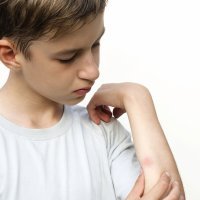 Cómo tratar picaduras de mosquitos y tábanos en los niños