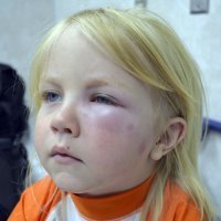 Tipos de reacciones alérgicas a las picaduras de insectos en los niños